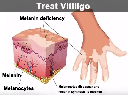 Treat Vitiligo Treat Vitiligo