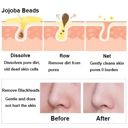 remove blackheads