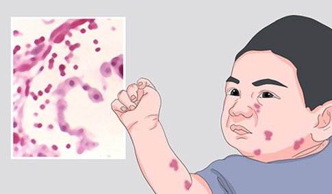 Skin infection Skin infection