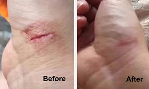 wound healing wound healing